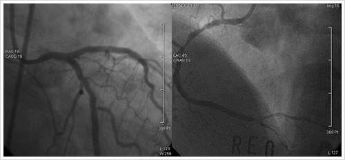 Kissing Stents