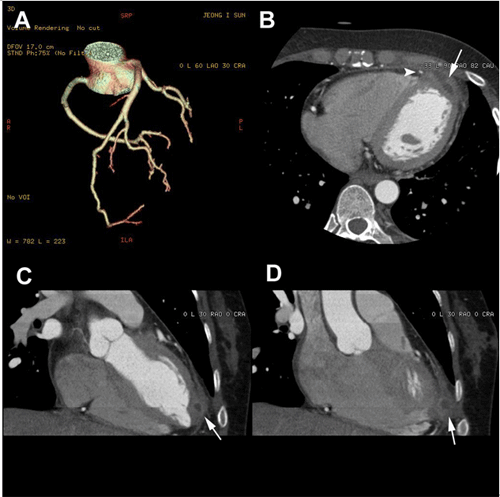 Coronary Ct